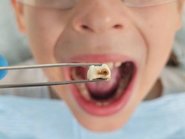 Best Emergency Dentist for Lost Fillings or Crowns in Garner, IA